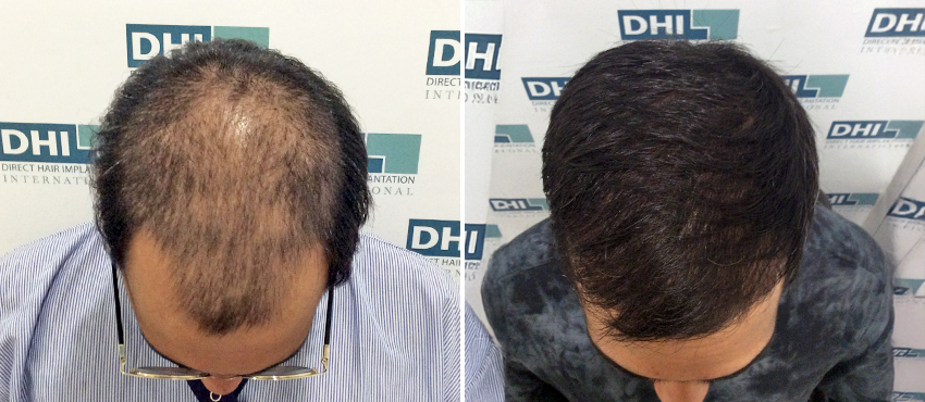 DHI before & after hair transplant results